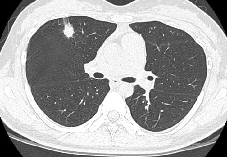 探索肺部健康的三大要点，最新肺部新闻揭秘肺部健康之路